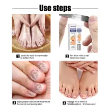 West&Month Nail Fungus Removal Cream Foot
