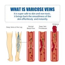 West&Month Varicose Veins Treatment Cream