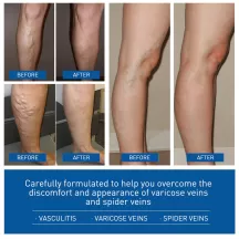 West&Month Varicose Veins Treatment Cream