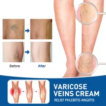 West&Month Varicose Veins Treatment Cream