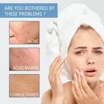 West&Month Herbal Acnes Removal Cream