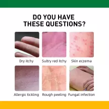 West&Month Itchy Psoriasis Cream