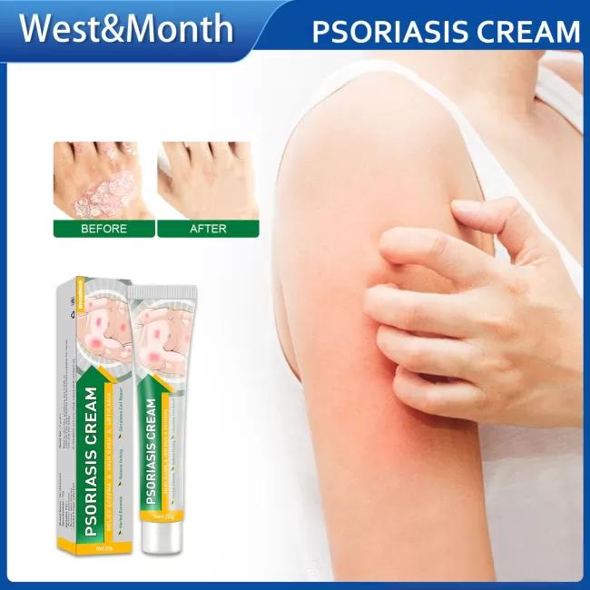 West&Month Itchy Psoriasis Cream