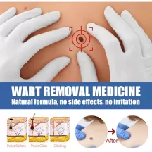 West&Month Wart Remover Skin Tags Removal Ointment